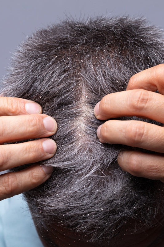 Skæl hos mænd – hvad er forskellen på skæl og tør hovedbund?